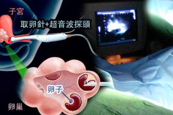 [香港市哪个医院可以做试管婴]试管婴儿的检查：多囊卵巢备孕2年无果怎么样才